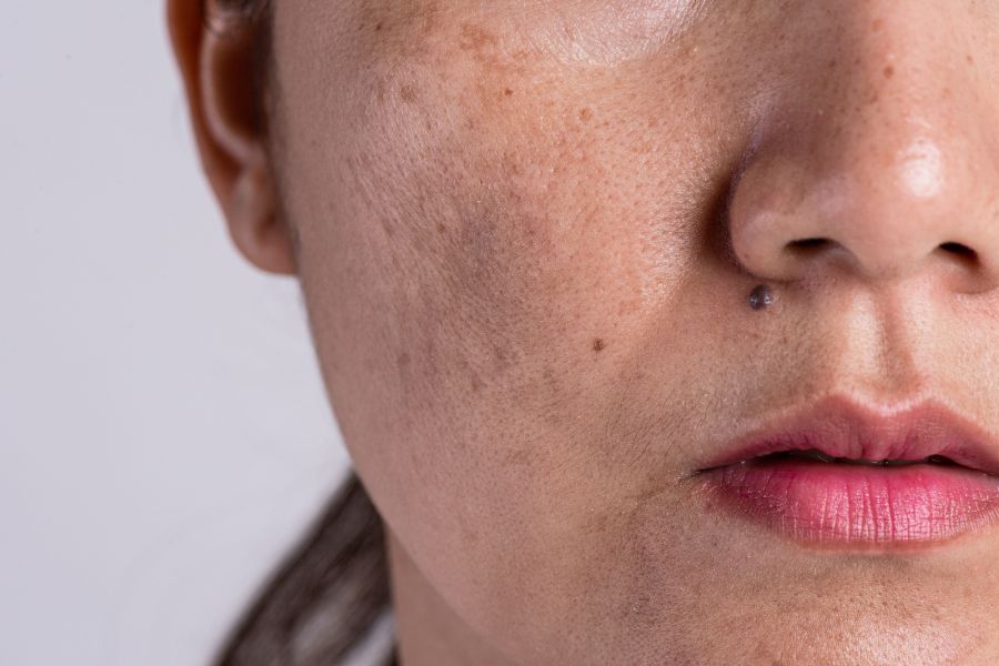 O que piora as manchas de melasma?